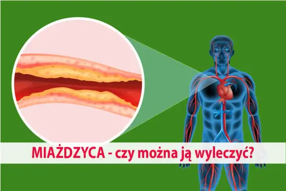 Miażdżyca - objawy, leczenie i jak ją spowolnić?