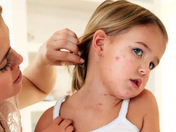 Sarpullido por fiebre en niños - cuándo consultar y qué vigilar