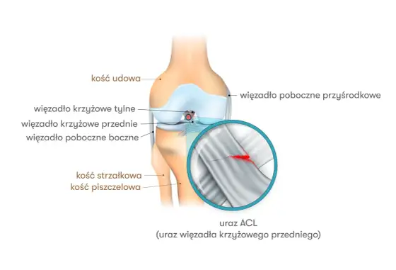 Uraz ACL w kolanie - objawy, leczenie i powrót do sportu