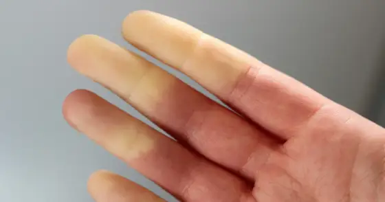 Objaw Raynauda - Kiedy to zimno, a kiedy choroba?