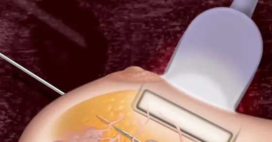 Biopsja mammotomiczna - Czy boli? Prawda o zabiegu i po nim
