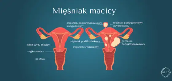 Rosnący mięśniak po menopauzie: Kiedy to sygnał alarmowy?