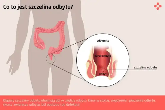 Szczelina odbytu - Ból i krwawienie po stolcu? Sprawdź, co to znaczy