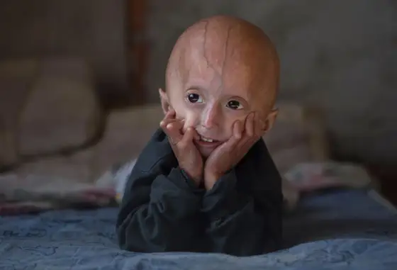 Progeria - nie tylko "szybkie starzenie". Poznaj fakty!