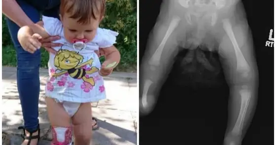 Strzelanie kości u niemowlaka – kiedy do lekarza?