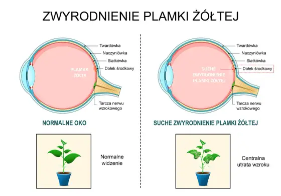 Objawy zwyrodnienia plamki żółtej - Nie ignoruj tych sygnałów