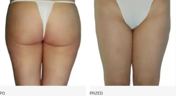 Endermologia: Jak często? Odstępy (2-3x/tydz.) dla trwałych efektów