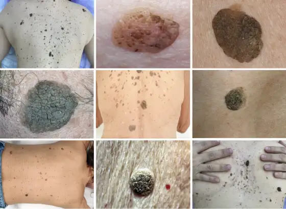 Kératose séborrhéique - Comment l'apaiser et quand consulter ?