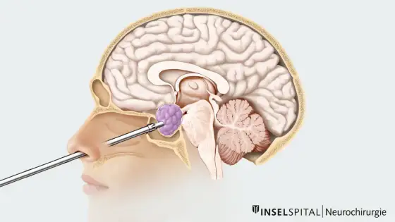 Hypophysentumor - Symptome, Diagnose & Behandlung verstehen