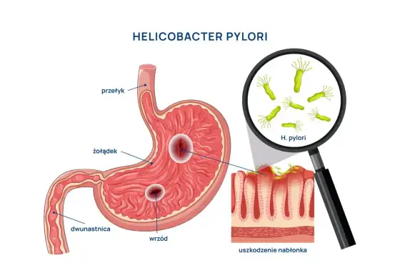 Najskuteczniejszy lek na Helicobacter pylori? Liczy się schemat