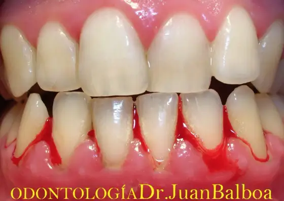 Gingivitis - ¿Sangran tus encías? Cómo actuar y prevenirlas