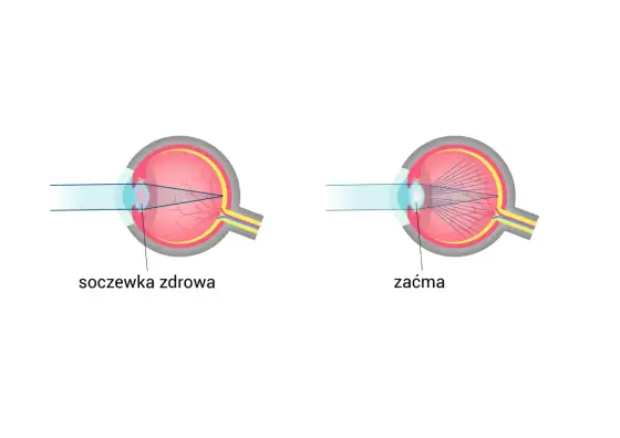 Spojówka - budowa, funkcje i objawy, których nie wolno lekceważyć