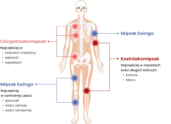 Mięsak kości - jak rozpoznać pierwsze objawy i skutecznie leczyć?