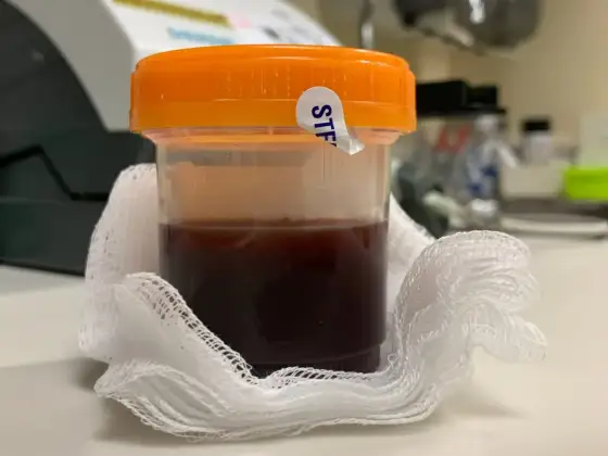 Alkaptonuria - tajemnicza choroba? Objawy, leczenie, życie z nią