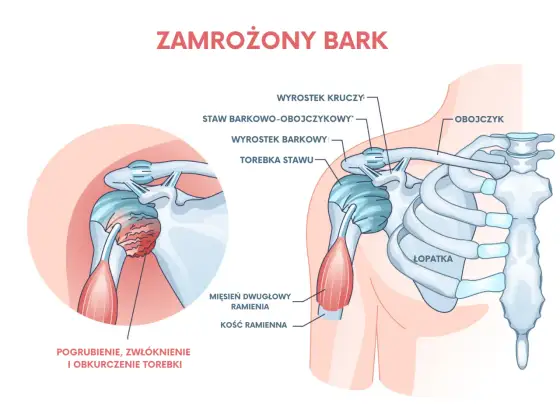 Nerw przeponowy - dlaczego daje duszność i ból barku?