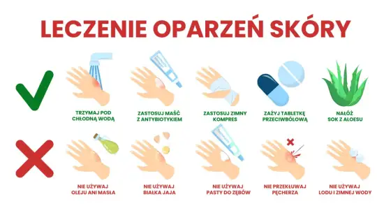 Oparzenia - Co robić, kiedy iść do lekarza? Poradnik