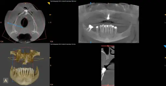 Tomografia stomatologiczna - Czy jest szkodliwa? Prawda o CBCT