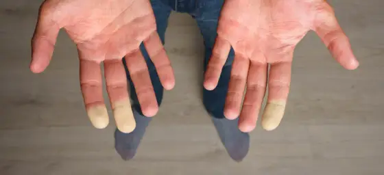 Objaw Raynauda - Jak rozpoznać napad i co realnie pomaga?