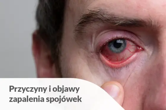 Obrzęk spojówki - Co oznacza i kiedy iść do lekarza?