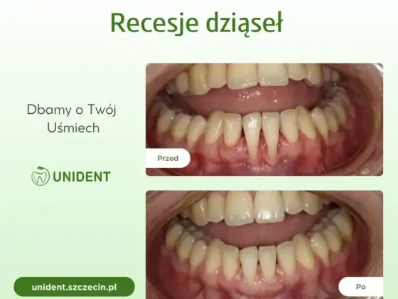 Recesja dziąseł przed i po - Czy leczenie zawsze działa?