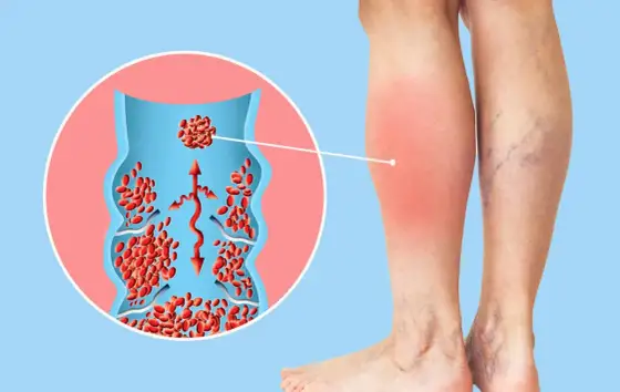 Thrombose im Alter - Symptome erkennen & richtig handeln