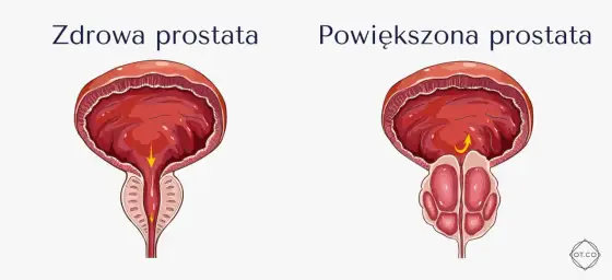 Leki na prostatę - Co naprawdę działa? Wybierz właściwą terapię!
