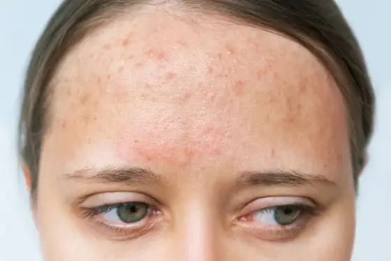 Alergia na mleko u dorosłych: objawy skórne, diagnoza i leczenie