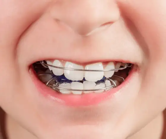 Jak wygląda ruchomy aparat na zęby dla dzieci? Wszystko, co musisz wiedzieć