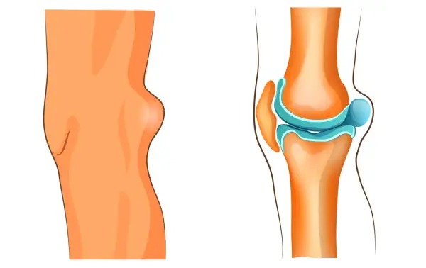 Knie mit Bakerzyste, die eine Schwellung hinter dem Kniegelenk zeigt. Die rechte Seite illustriert das Kniegelenk und die mögliche Bakerzyste, die eine Behandlung erfordert.