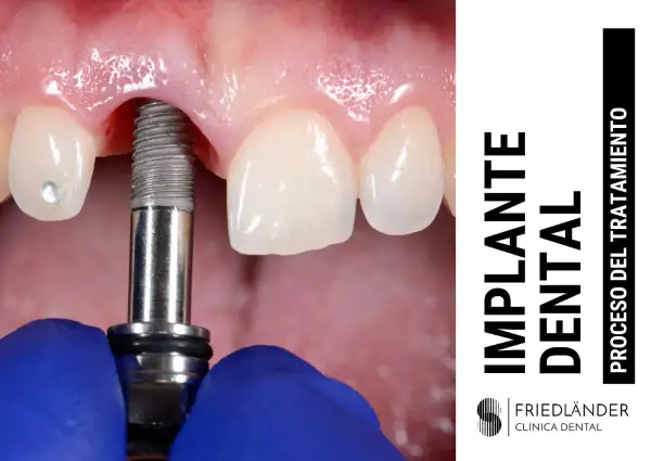 Proceso de colocación de un implante dental. Un tornillo metálico se inserta en la encía, cerca de dientes naturales.