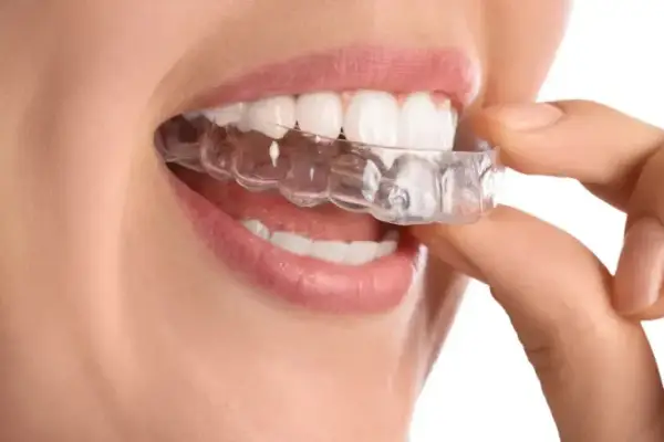 Dita che posizionano un apparecchio di contenzione trasparente sui denti bianchi.