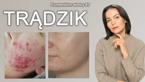 Czysta cera bez trądziku? Odkryj sekrety skutecznej profilaktyki