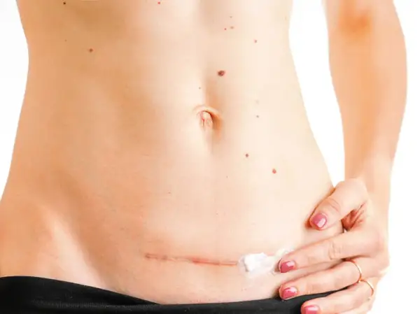Frau trägt eine Creme auf eine Narbe am Bauch auf. Natürliche Hausmittel für die Narbenpflege können hier helfen.