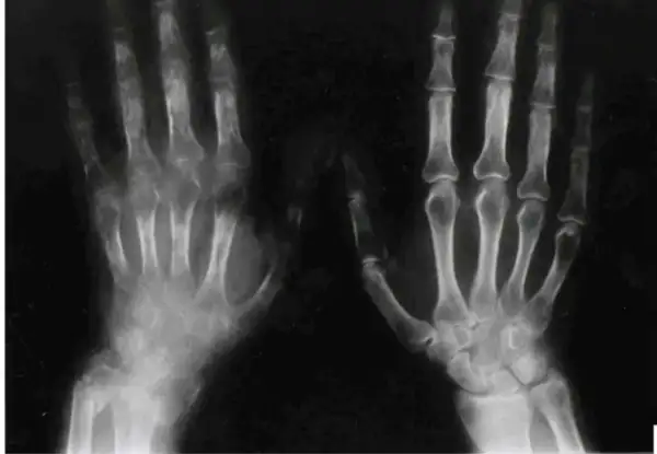 RTG dłoni ukazujący zmiany kostne charakterystyczne dla zespołu sudeckiego. Widoczne są objawy osteoporozy, obrzęki i zwężenia przestrzeni stawowych.
