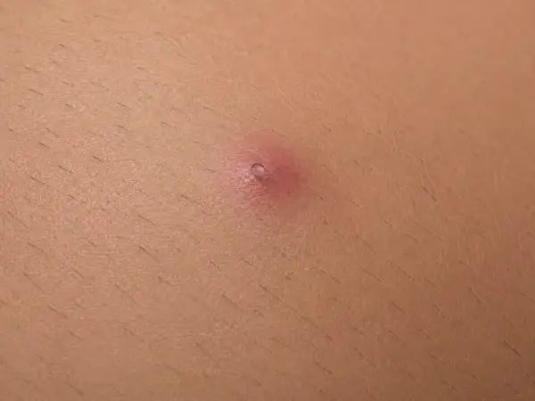 Primo piano di un pelo incarnito, un piccolo brufolo rosso sulla pelle. Ecco come togliere un pelo incarnito.