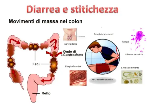 Illustrazione del colon con feci, che mostra movimenti di massa. Diverse cause di diarrea e stitichezza sono elencate, tra cui ipertiroidismo, allergie alimentari e infezioni.