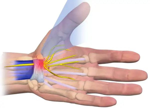 Illustrazione anatomica dei nervi del polso, evidenziando la compressione e l'infiammazione dei nervi che si diramano verso le dita.