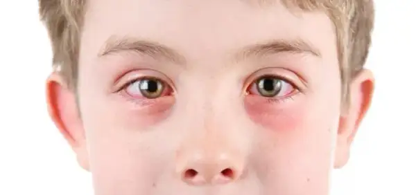 Alergia oczu: objawy, rozpoznanie i skuteczne sposoby na ulgę
