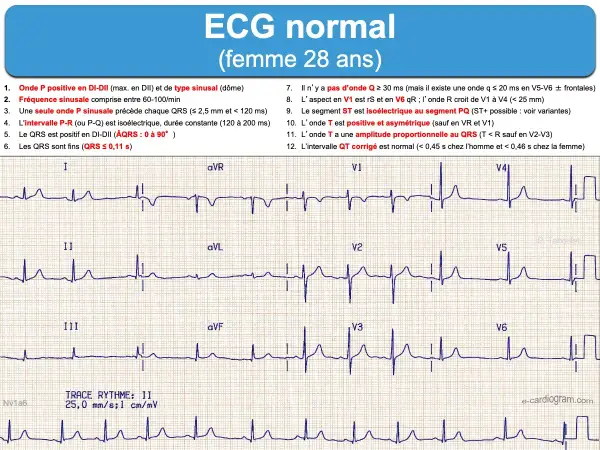 Électrocardiogramme (ECG) d'une femme de 28 ans, montrant un cycle cardiaque normal avec des ondes P, QRS et T caractéristiques.