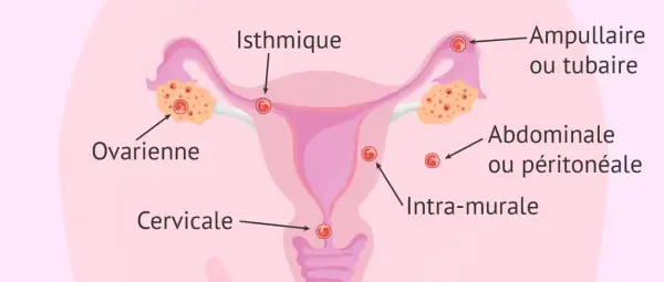 Schéma illustrant les différents sites d'une grossesse extra-utérine : ovarienne, isthmique, ampullaire, abdominale, cervicale et intra-murale.