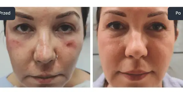 Przed i po zabiegu z użyciem egzosomów. Skóra twarzy przed zabiegiem jest zaczerwieniona i podrażniona, po zabiegu jest wygładzona i zregenerowana.