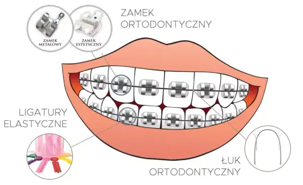 Jak założyć aparat na zęby? Etapy, koszty i pierwsze dni
