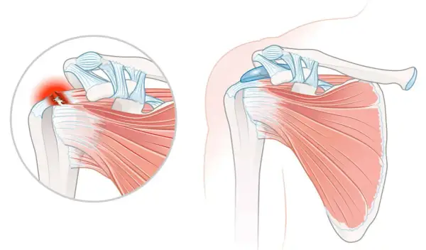 Schulteransicht mit Darstellung einer Tendinopathie der Supraspinatussehne, die entzündet und gerissen ist.