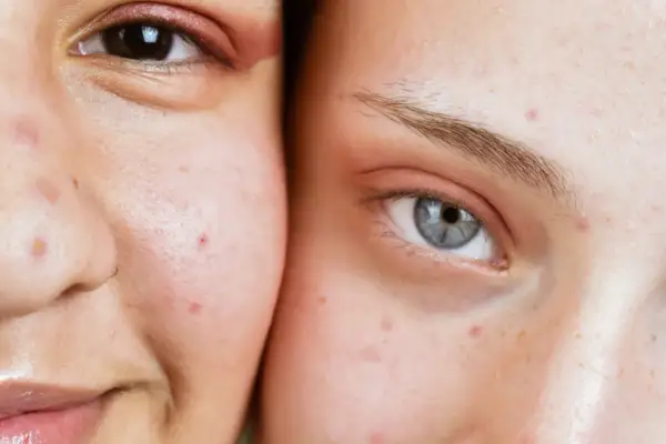 Visages de deux personnes montrant des imperfections cutanées, possiblement des maladies de peau dues au stress.