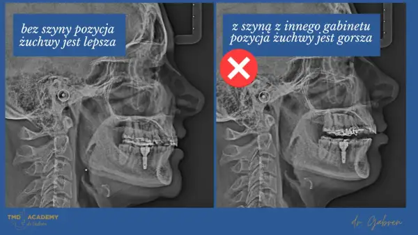 Porównanie RTG czaszki: po lewej bez szyny na staw skroniowo żuchwowy, pozycja żuchwy lepsza. Po prawej z szyną, pozycja gorsza.