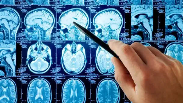 Rezonans magnetyczny a choroby psychiczne: co naprawdę wykryje MRI?
