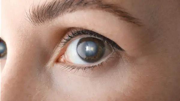 Zbliżenie oka z widoczną zaćmą korową, która powoduje zmętnienie soczewki i utratę ostrości widzenia.