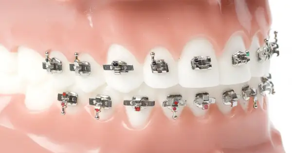 Modello di denti con apparecchio ortodontico, con attacchi metallici e fili che sembrano piccole stelline.