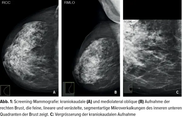 Mammografie-Aufnahmen zeigen feine, lineare Mikroverkalkungen in der Brust.