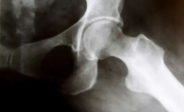 RTG stawu biodrowego z widocznym zwyrodnieniem. Kości są nierówne, z osteofitami, co wskazuje na chorobę zwyrodnieniową stawu biodrowego.